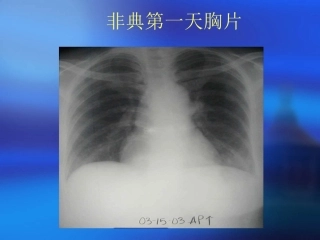 急性肺损伤和急性呼吸窘迫