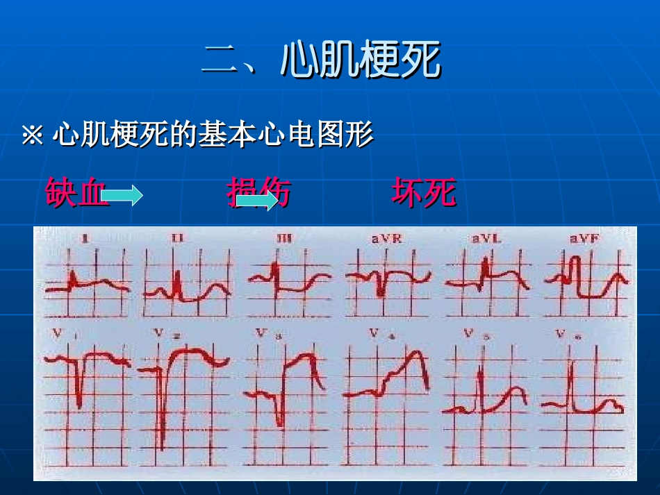 急性心肌梗死的心电图演变_第3页