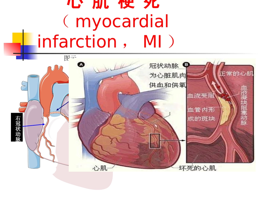 急性心肌梗死_第2页