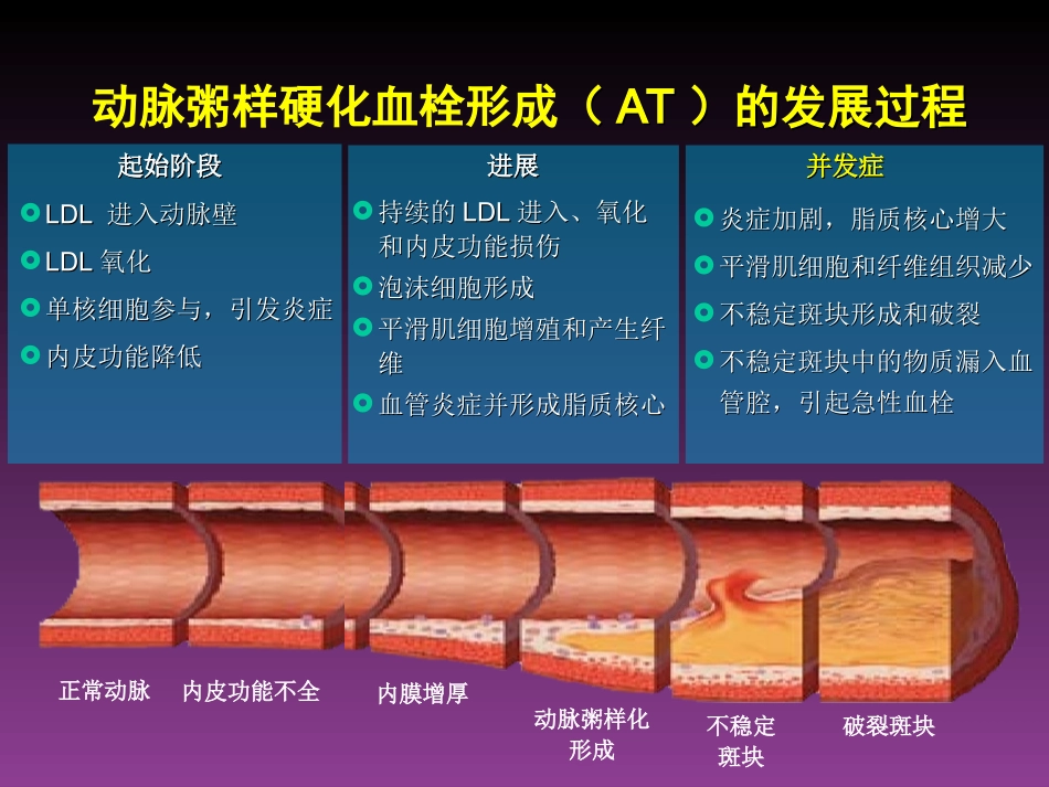 急性冠脉综合征的当代新理念(讲稿)1_第2页