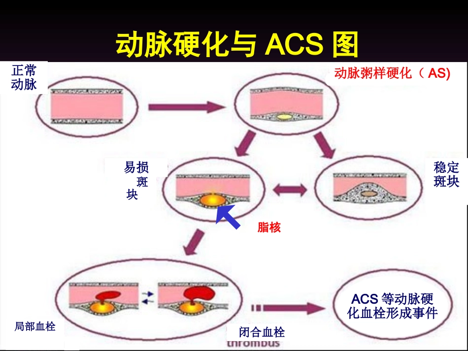 急性冠脉综合征的当代新理念(讲稿)1_第3页