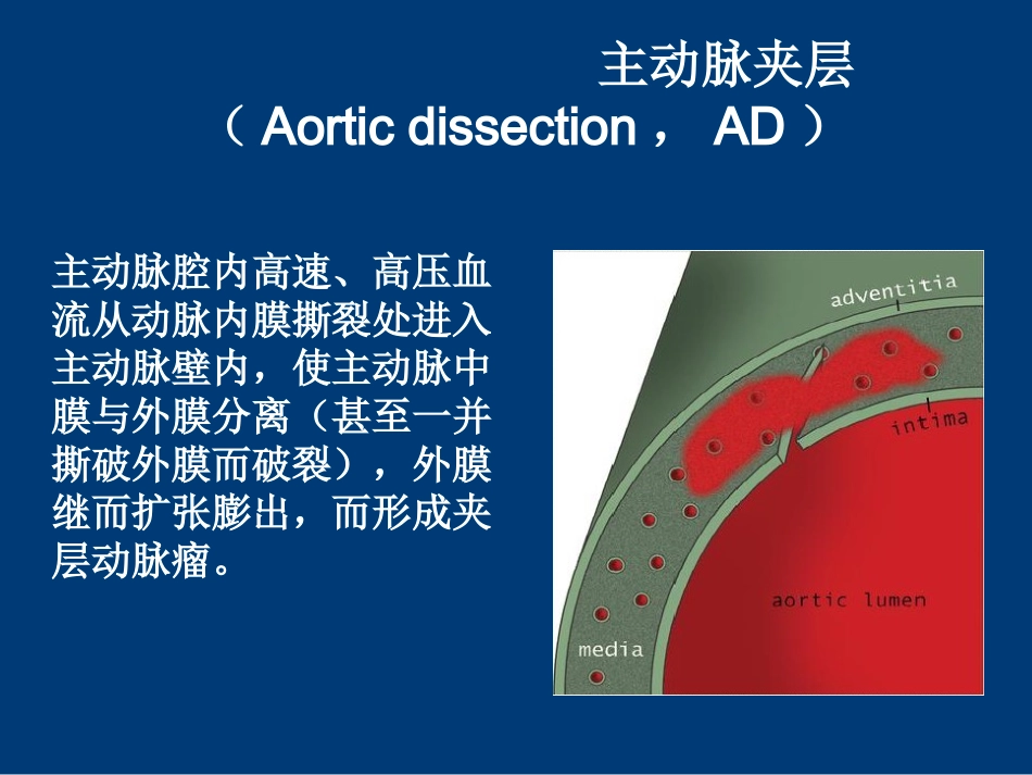 急性主动脉综合征_第3页