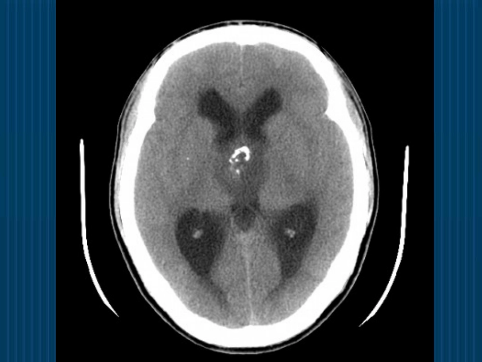怎么看头颅CT与MRI_第3页