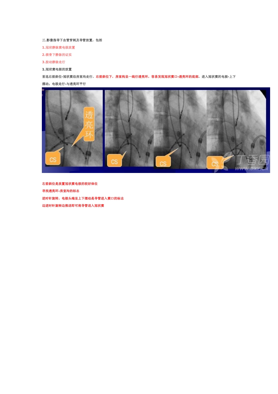心脏电生理介入扫盲贴_第3页