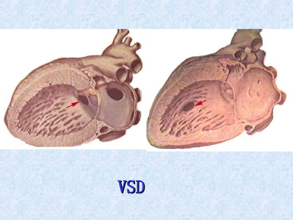常见的几种先心病_第3页