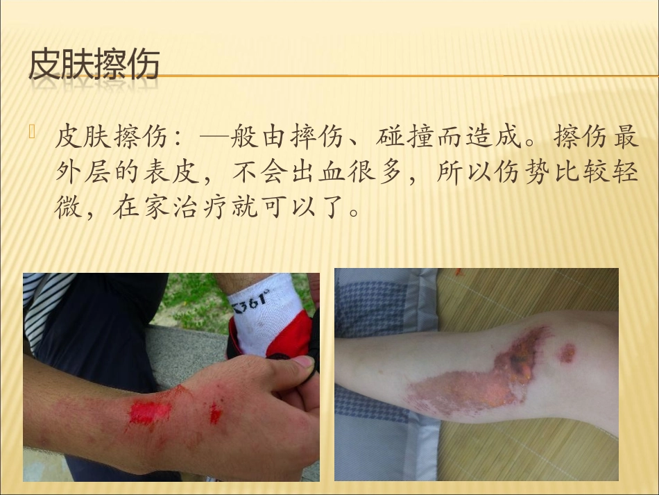 常见外伤处理方法_第3页