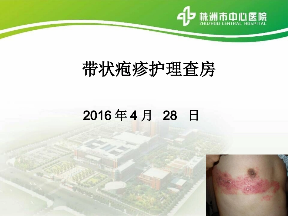 带状疱疹查房_第1页