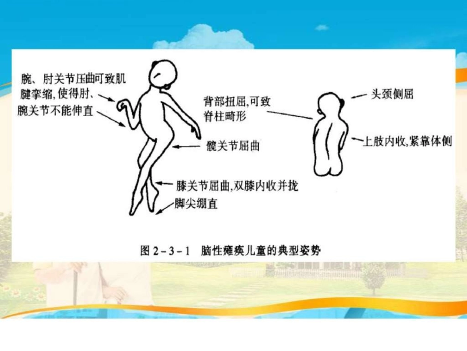 小儿脑瘫的康复训练图文ppt_第2页