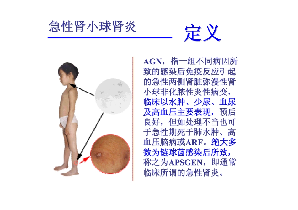 小儿急性肾小球肾炎..ppt_第2页