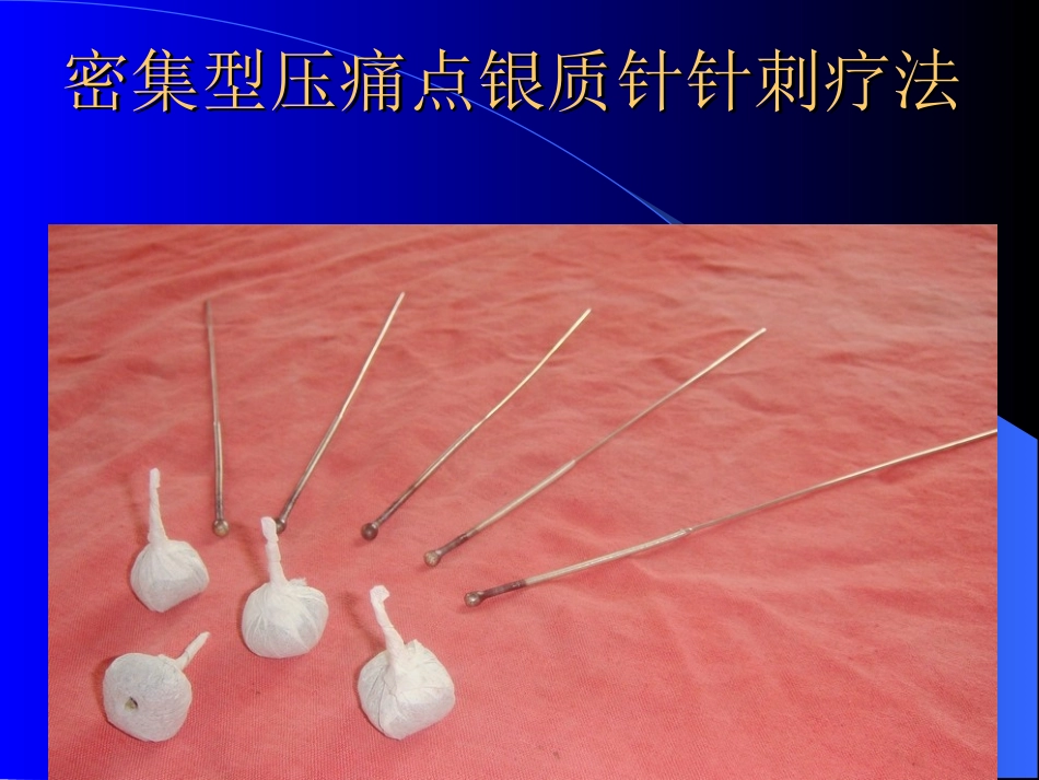 密集型压痛点银质针针刺疗法_第1页