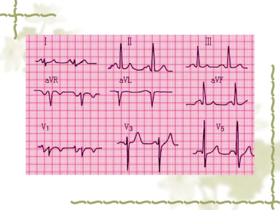 实验诊断学：异常心电图检查_第3页