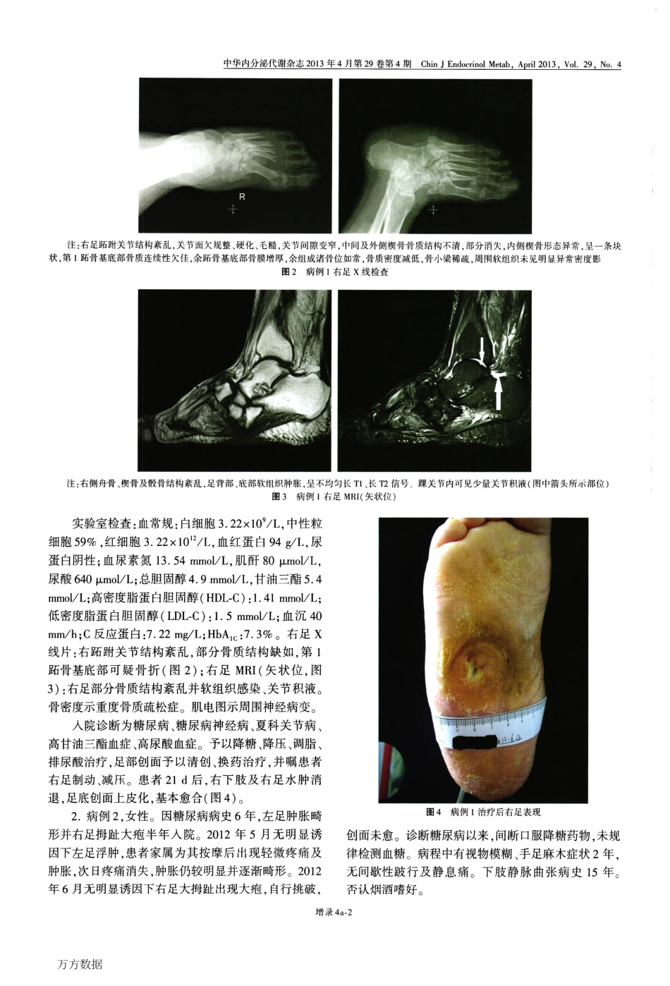 夏科关节病_一种既易诊断也易漏诊误诊的糖尿病并发症_第2页