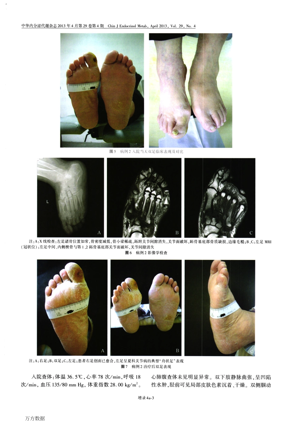 夏科关节病_一种既易诊断也易漏诊误诊的糖尿病并发症_第3页