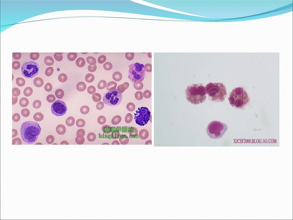 嗜酸性粒细胞性_第3页