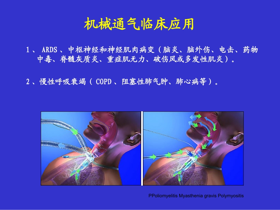 呼吸机参数调节和监测_第3页