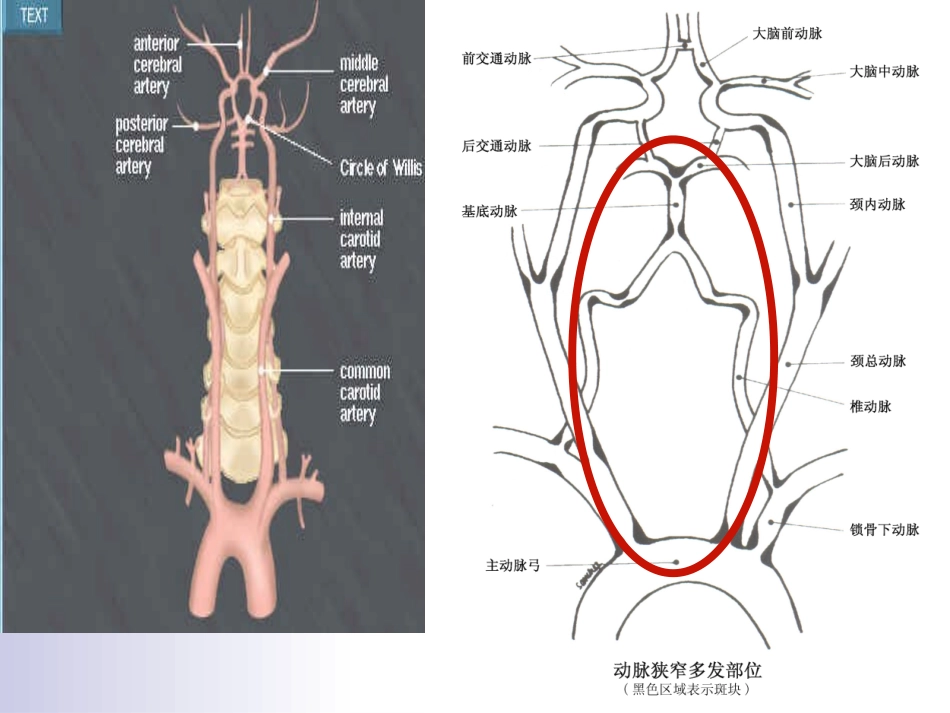 后循环缺血专家共识_第3页