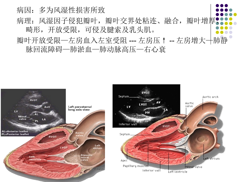 后天获得性心脏病瓣膜病_第3页
