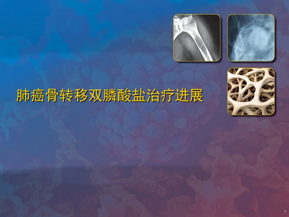 双膦酸盐在肺癌中骨转移的进展_第1页