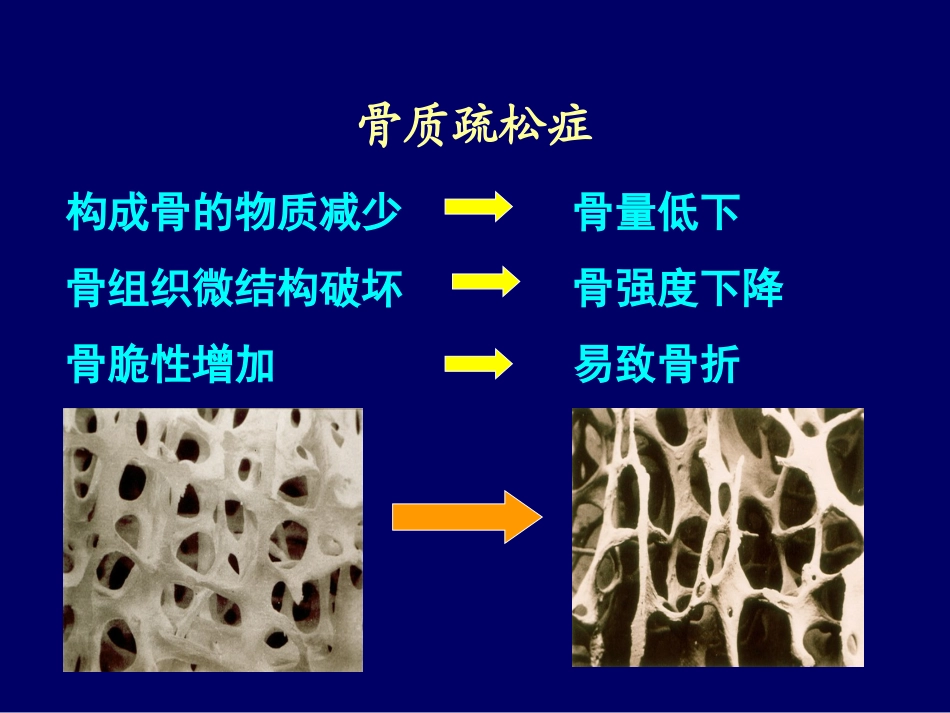 原发性骨质疏松症_第3页