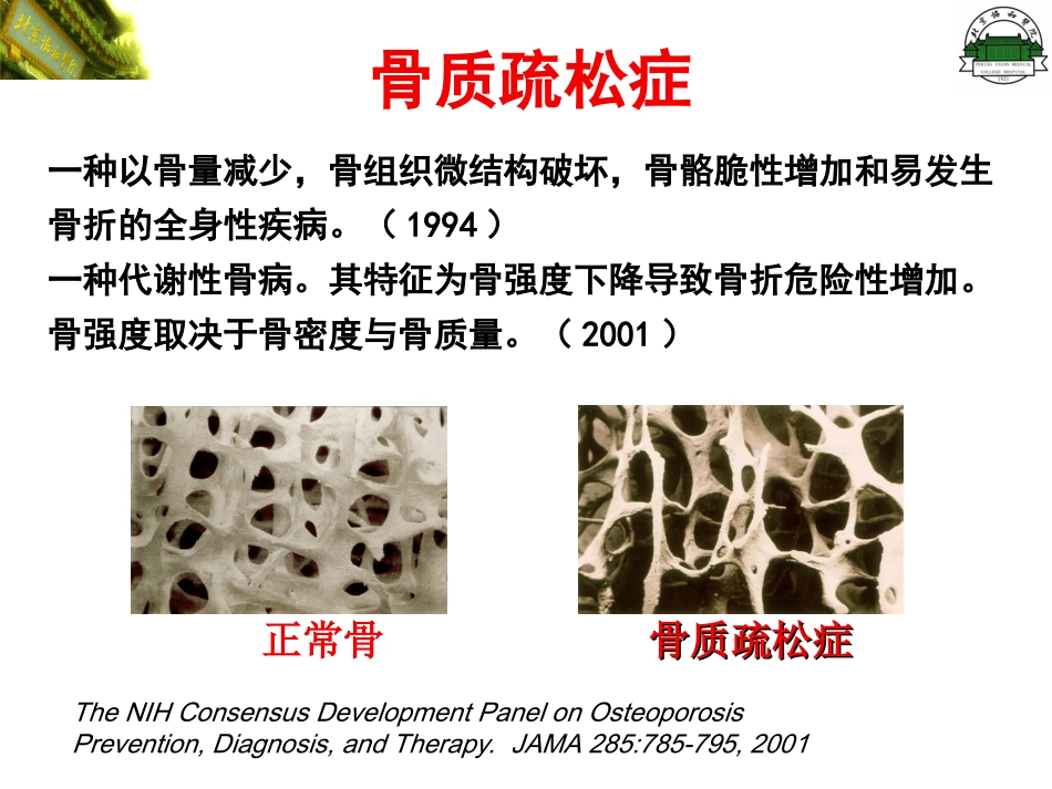 原发性骨质疏松症(修改)_第3页