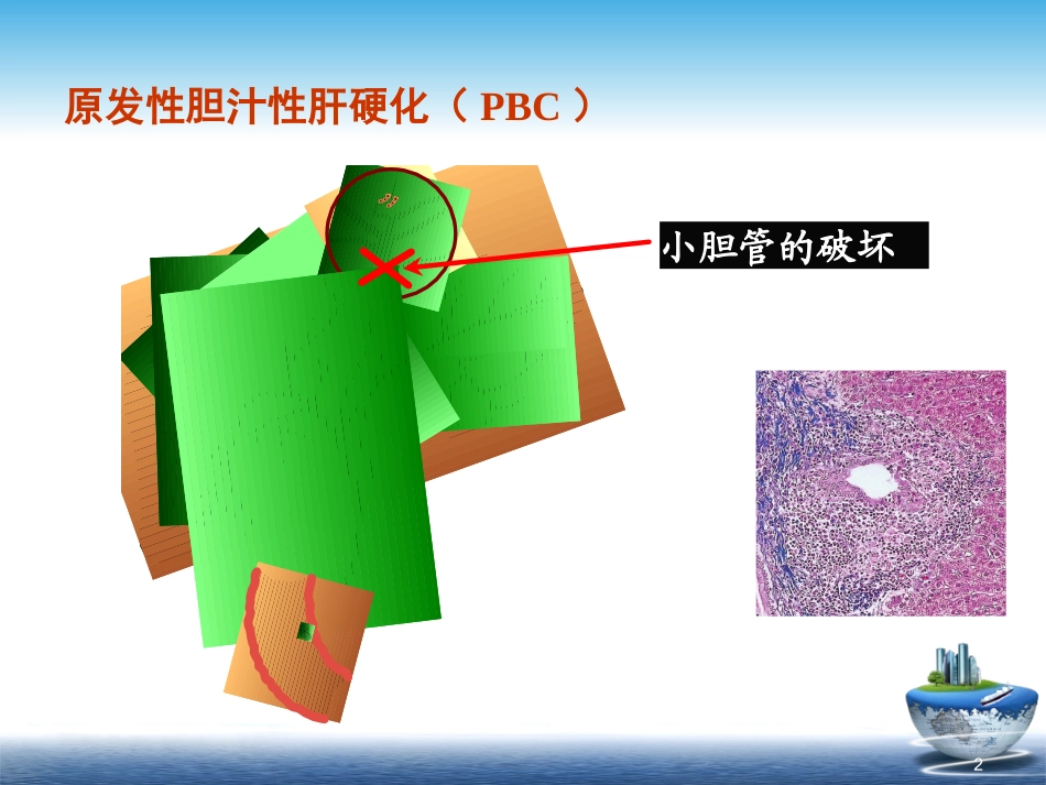 原发性胆汁性肝硬化2015诊治共识解读_第2页