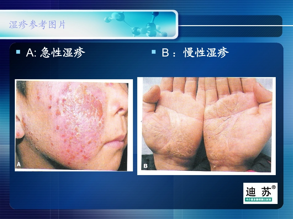 卡介菌多糖核酸有效治疗湿疹_第3页