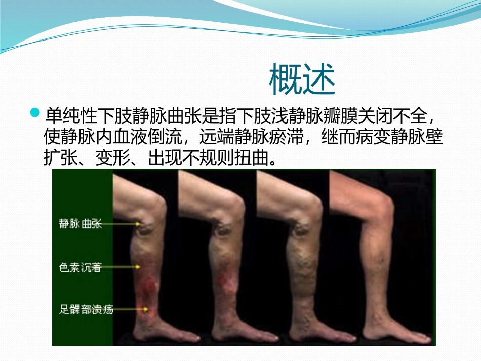 单纯性下肢静脉曲张_第2页