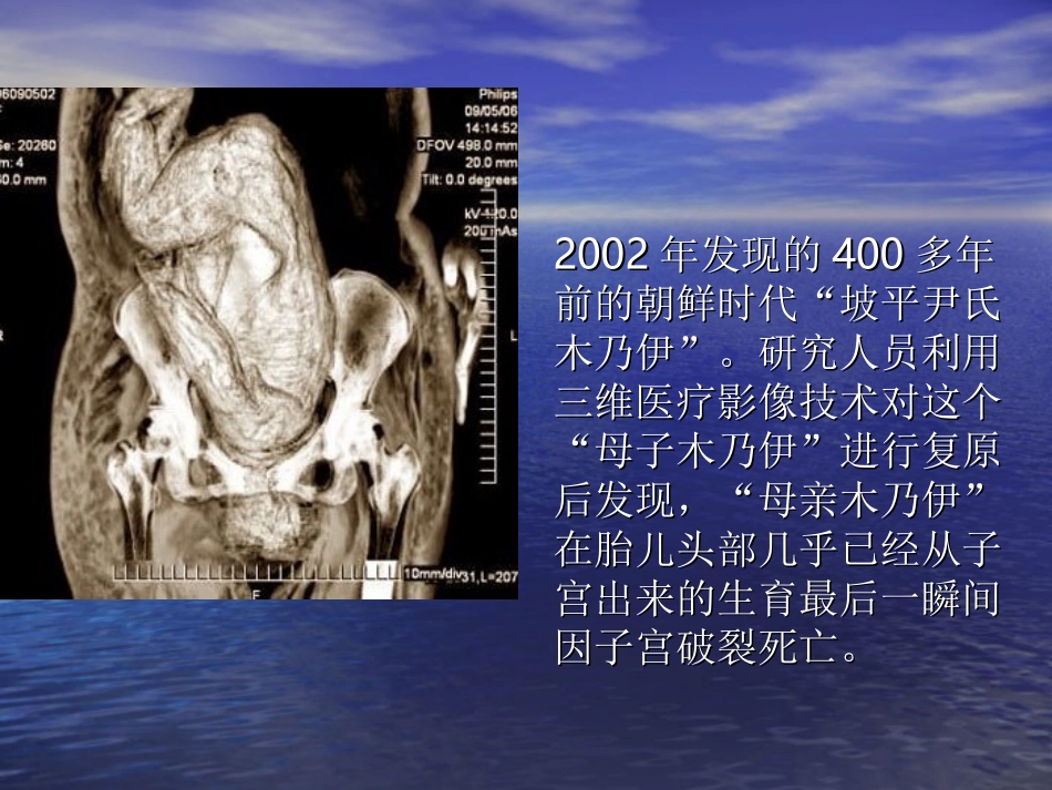 剖宫产术后再次妊娠的_第2页