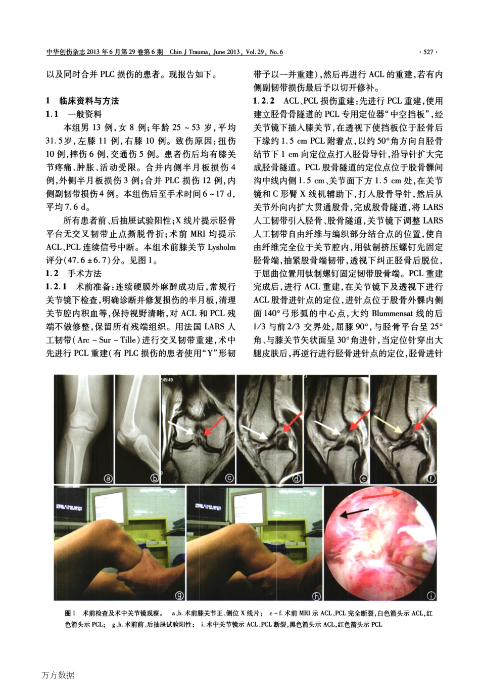 关节镜下使用LARS人工韧带重建膝前、后交叉韧带_第2页