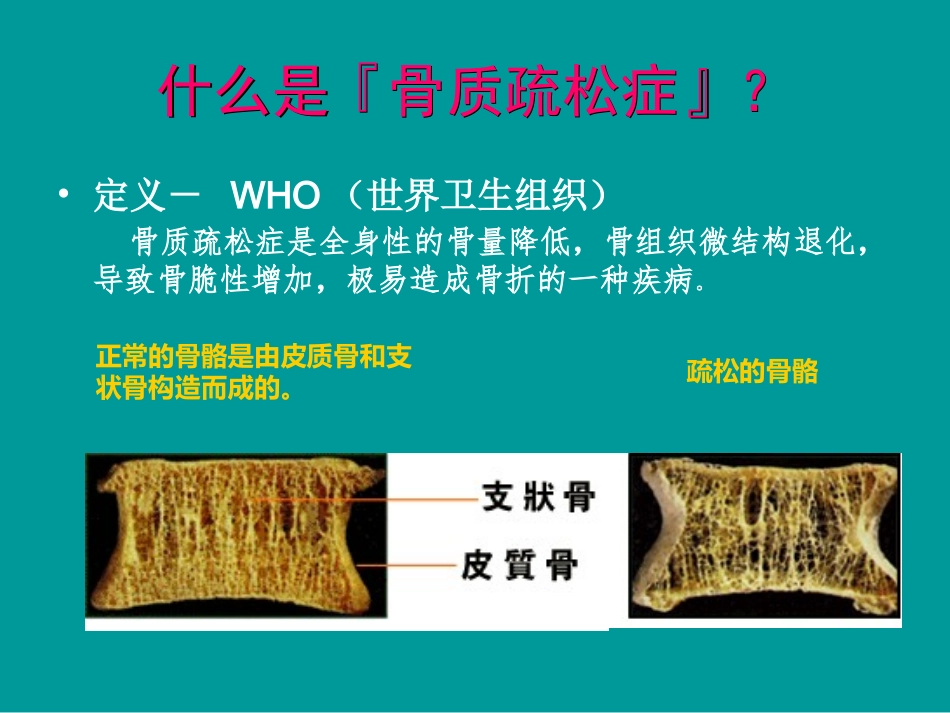 关节痛之骨质疏松_第2页