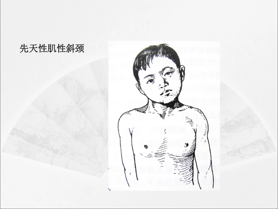 先天性肌性斜颈的康复_第3页