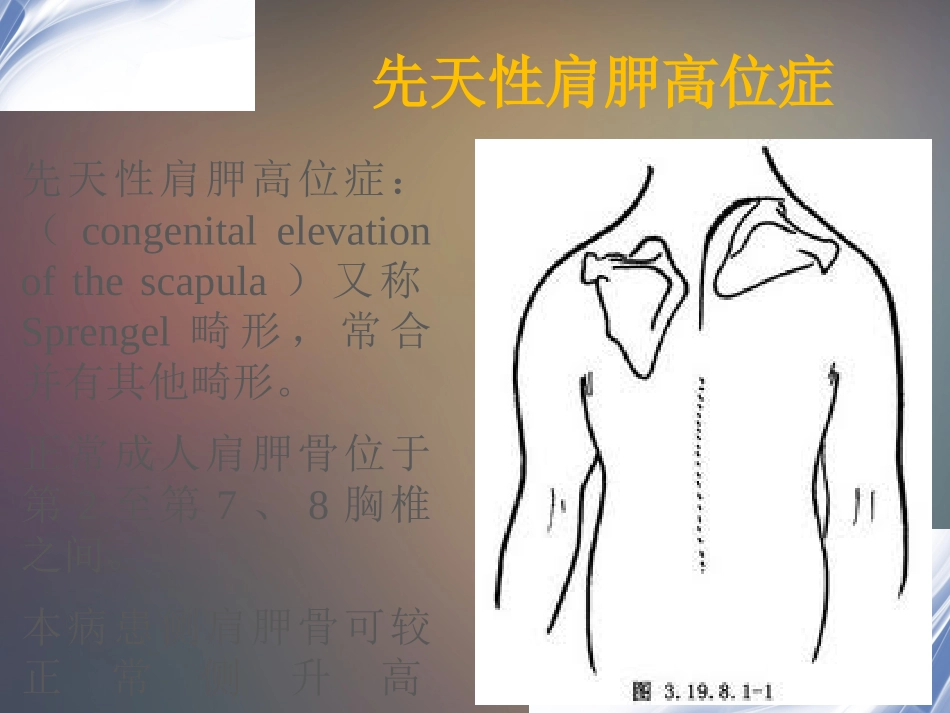 先天性高肩胛症_第2页
