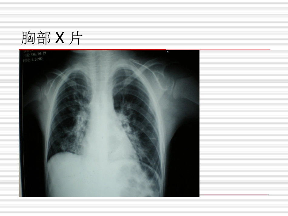 儿童甲型H1N1重症诊治探讨_第3页