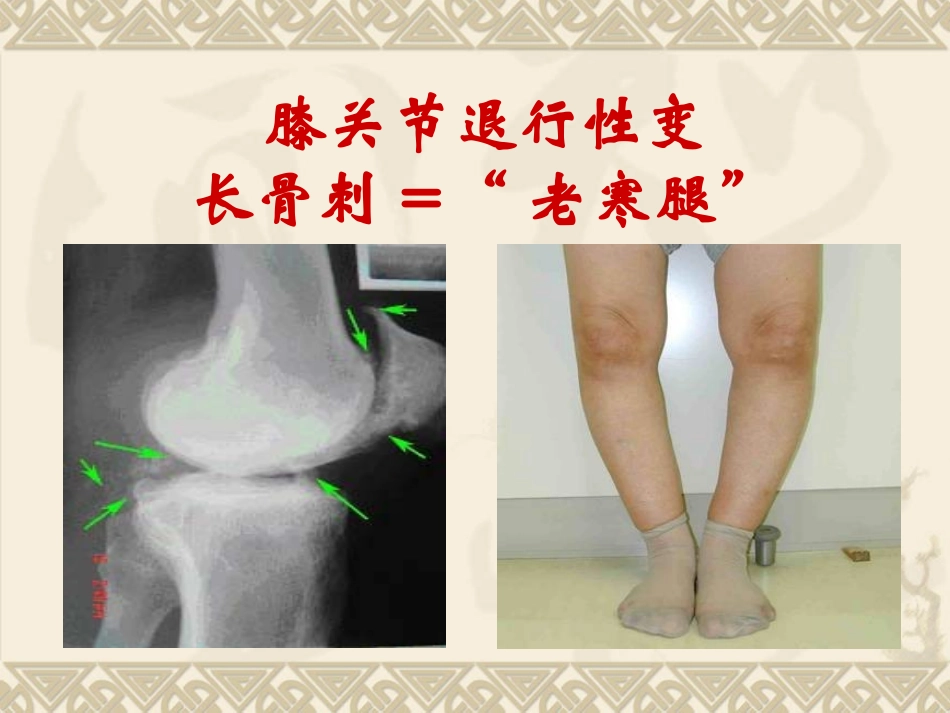 健康知识讲座膝关节_第3页