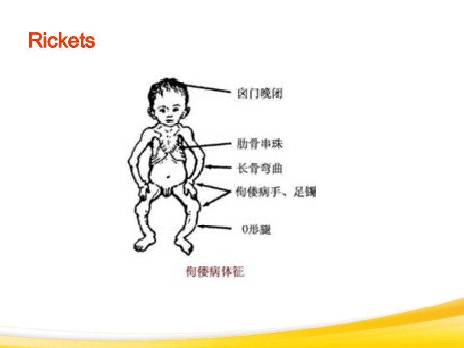 佝偻病与手足搐搦2013_第3页