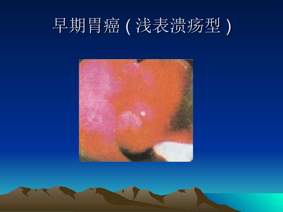 什么是胃癌？._第3页