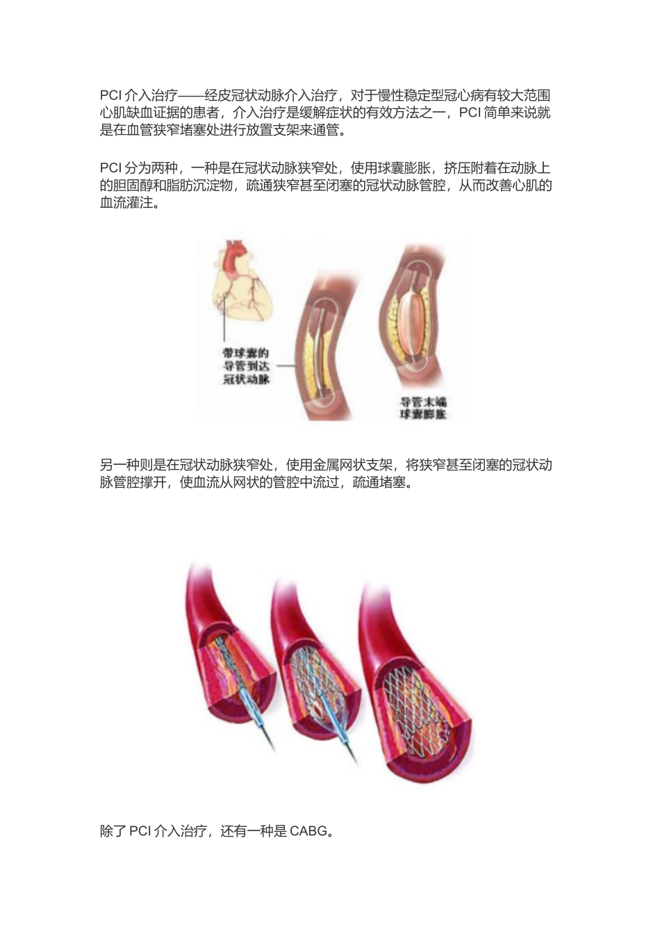 什么是冠心病_第3页