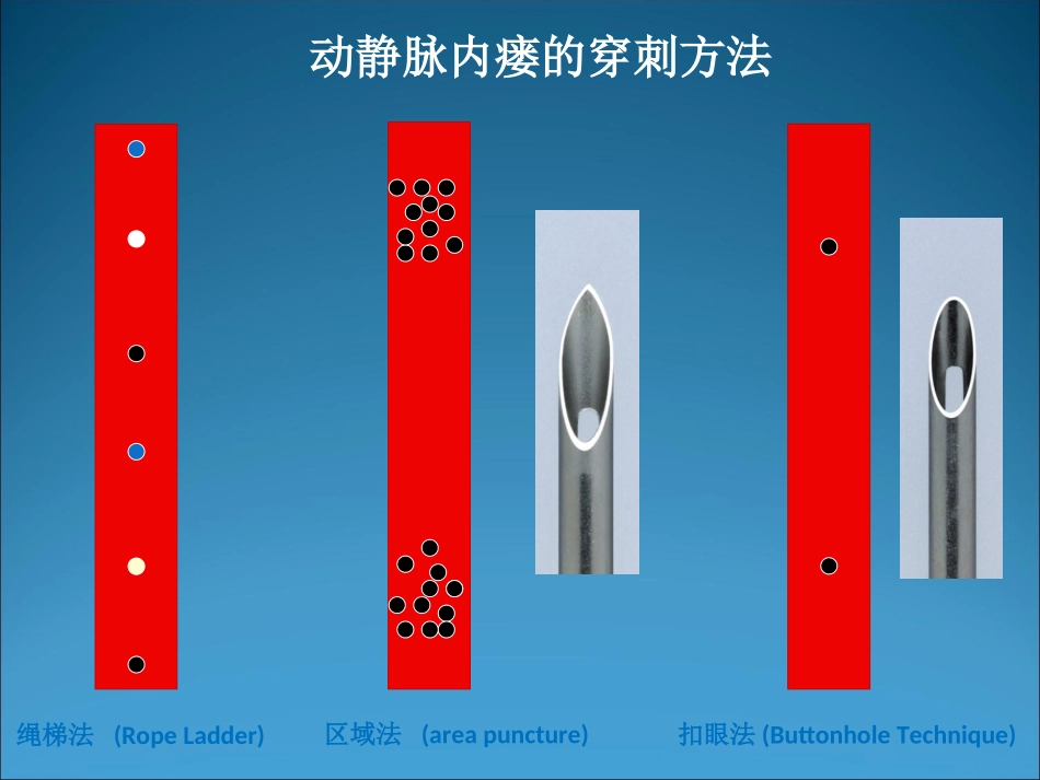 人工血管的绳梯穿刺海淀医院_第3页