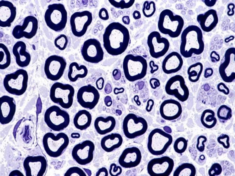 中毒性周围神经病_第3页