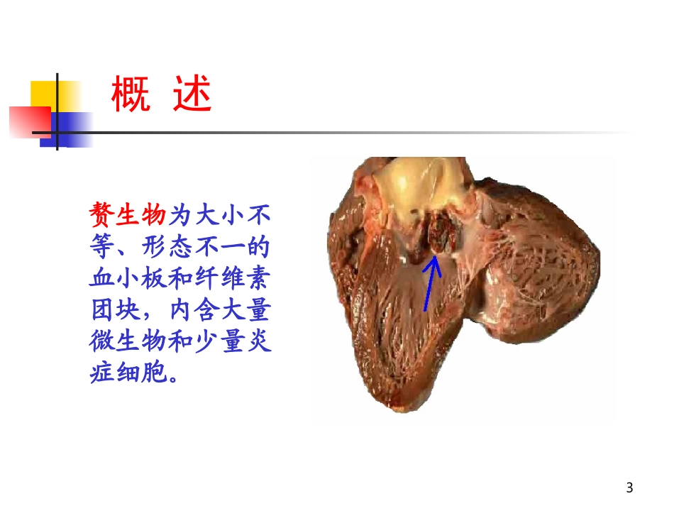 感染性心内膜炎(2学时)_第3页