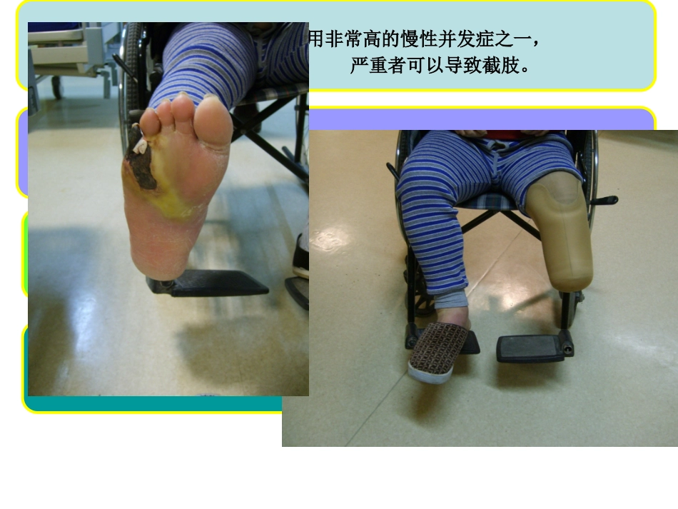 糖尿病足病筛查及创面处理_第3页