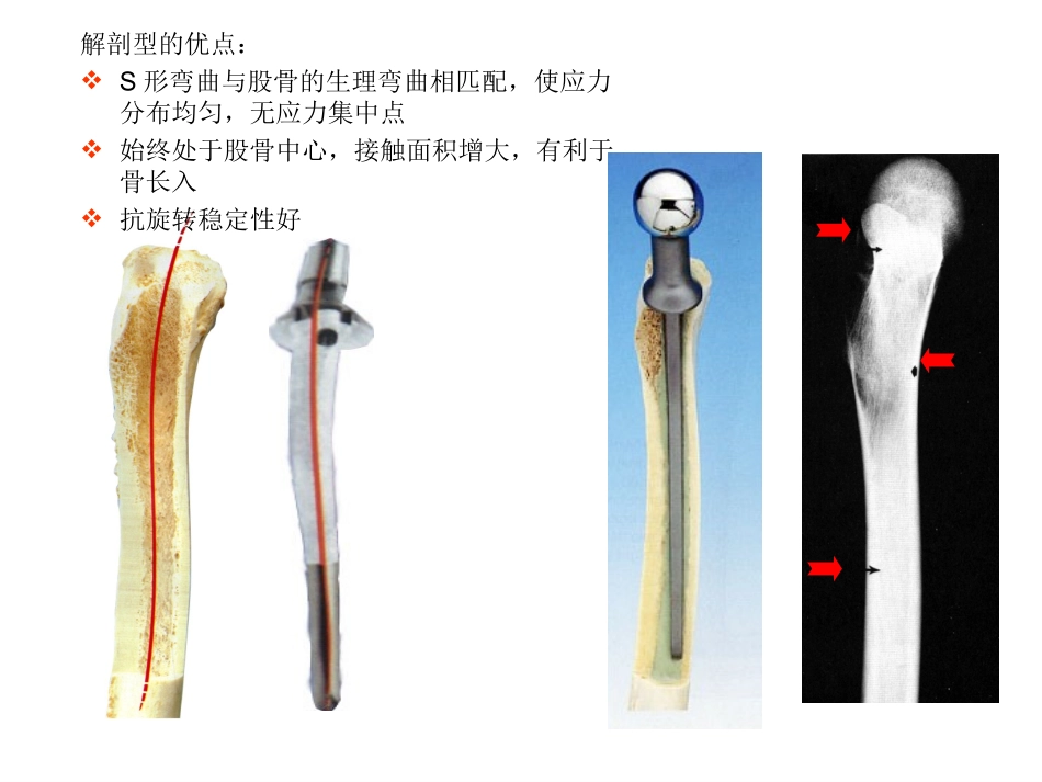 常用髋关节假体类_第3页