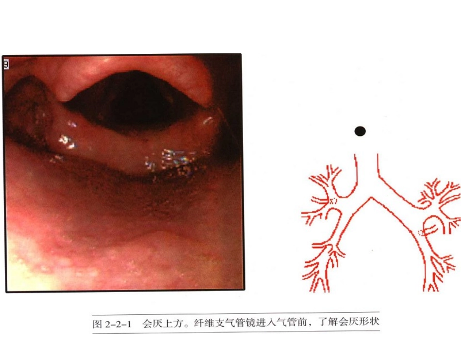 纤支镜图谱ppt【最经典纤维支气管镜图谱】_第3页