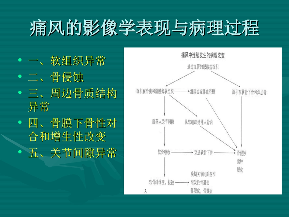 痛风影像学表现及进展_第2页