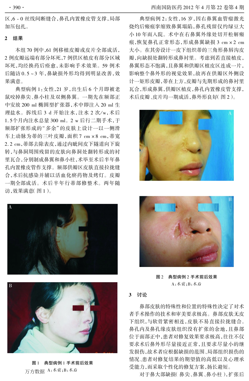 鼻部缺损修复的临床总结_第2页