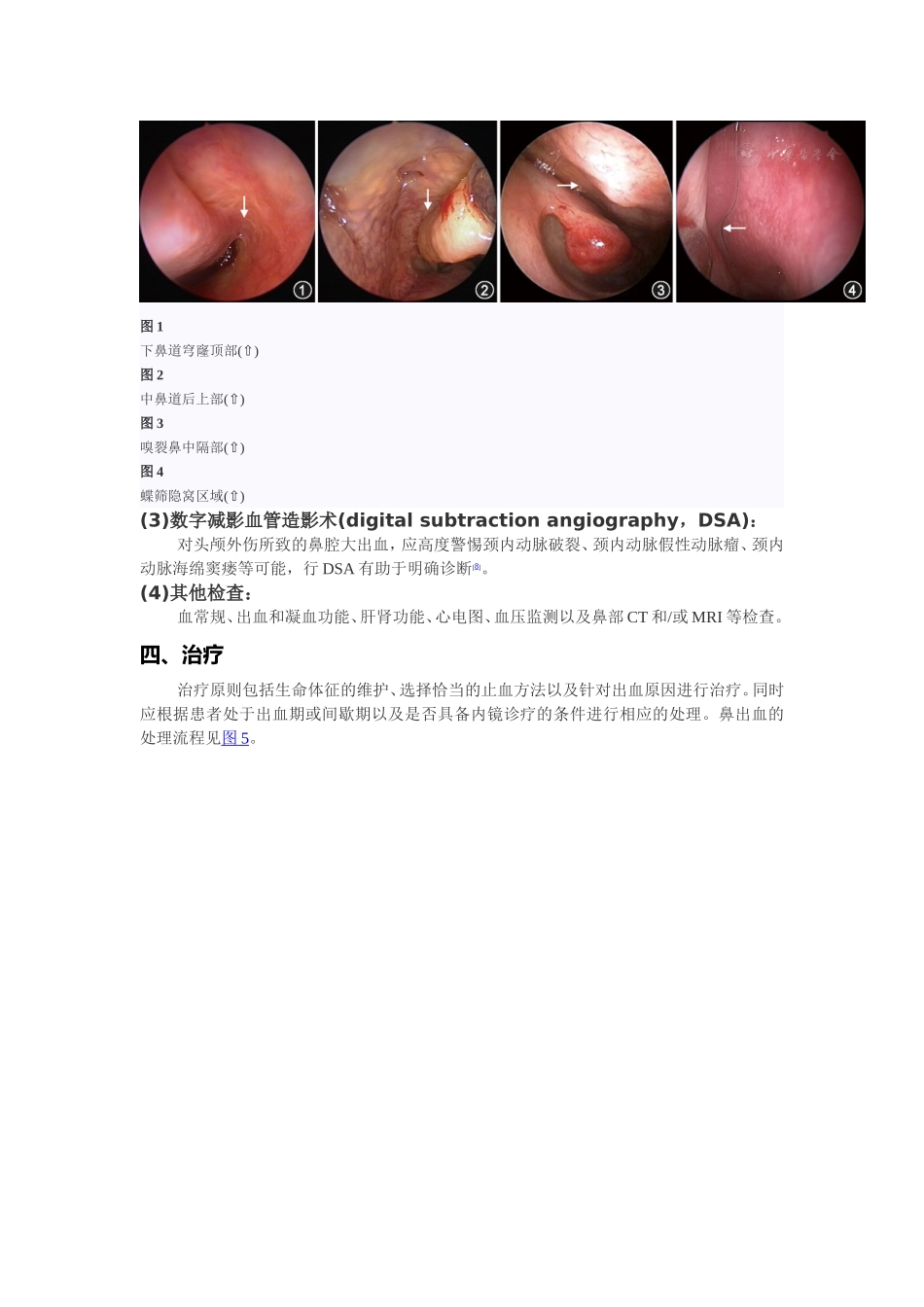 鼻出血诊断及治疗指南(草案)_第2页