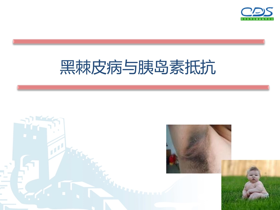 黑棘皮病与胰岛素抵抗_第1页