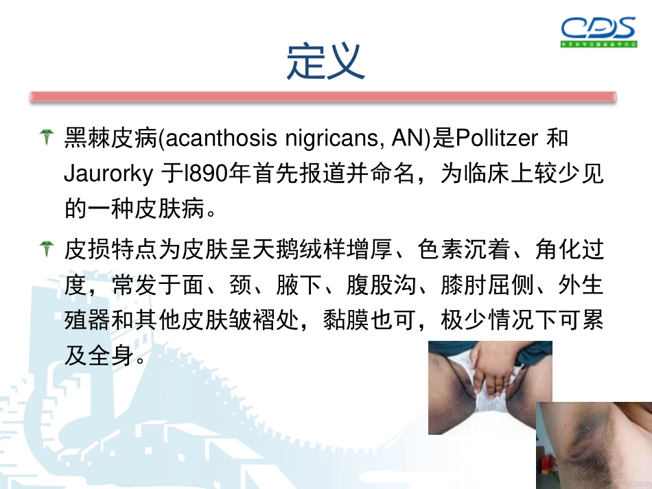 黑棘皮病与胰岛素抵抗_第2页