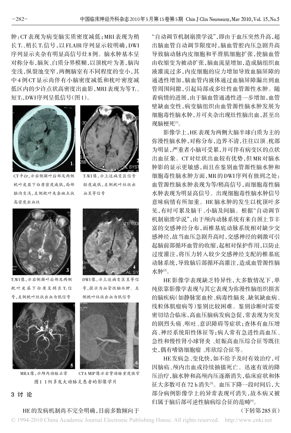 高血压脑病影像学特征分析_第2页
