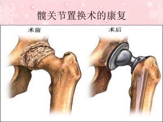 髋关节置换术的康